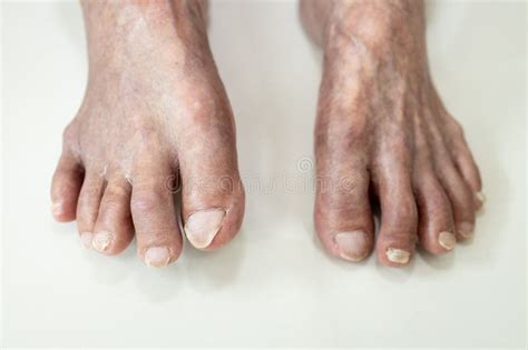 Dirty Feet and Toes of Old Elderly People,Long Toenails,lack of Care and Attention in Helping ...