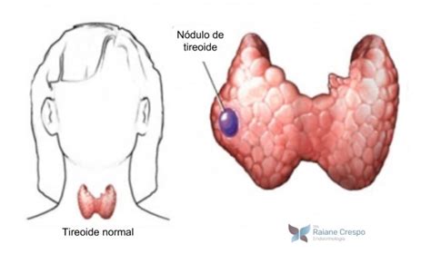 Qual O Tamanho Normal De Um Nódulo Na Tireoide - Nódulo de Tireoide | Dra. Raiane Crespo - Endocrinologia e Metabologia
