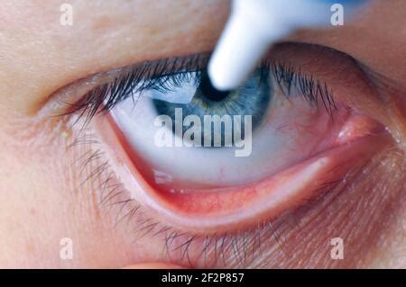 Implementation drug in conjunctival sac. Instill eye ointment Stock ...