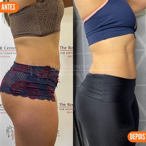 Definição Abdominal | Roosevelt Center