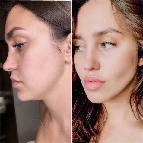 Процедуры инъекции липолитиков от 2490 руб/мл - BeautyWay Clinic 8 (499 ...