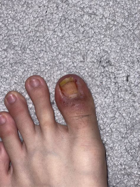 Pre to post surgery progress : r/Ingrown_Toenails