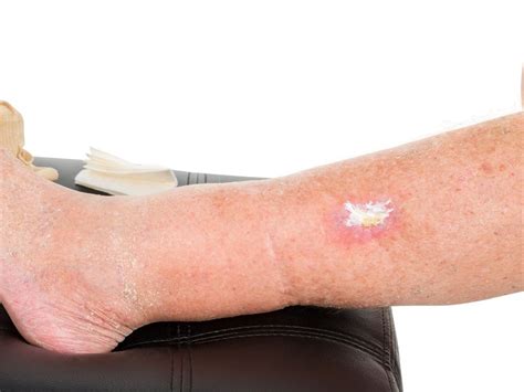 infizierte wunde erkennen und behandeln dermolex