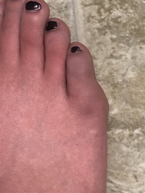 My toes are numb, cold, blue, and swollen with no trauma. My doctor is