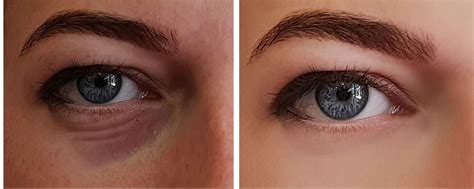 How To Get Rid Of Eye Bags - London Premier Laser & Skin Clinic