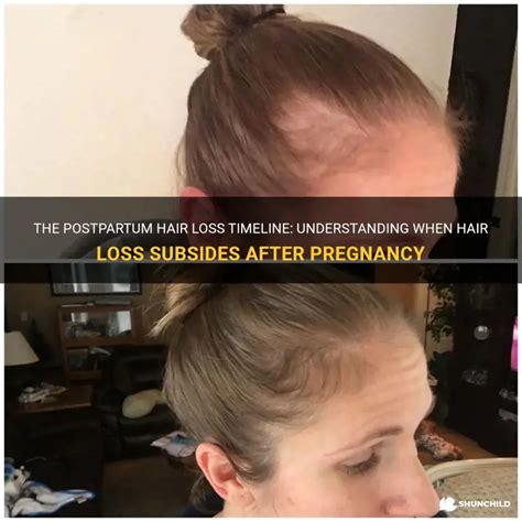 The Postpartum Hair Loss Timeline: Understanding When Hair Loss ...