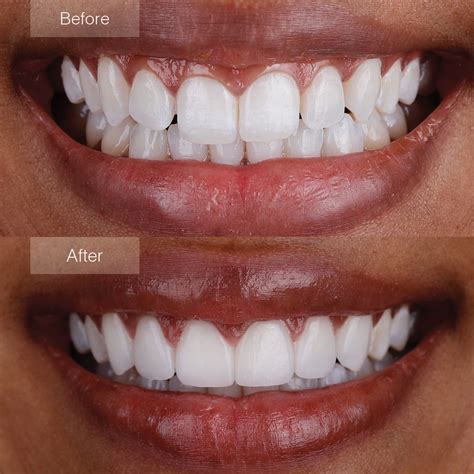 Porcelain Veneers Before and After - The Dental Room