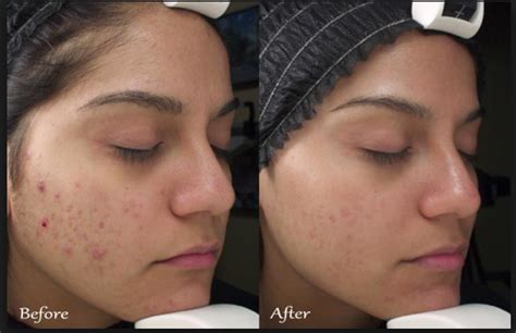 Clindoxyl Gel Antes E Depois - Clindoxyl Jel Hangi Durumlarda Kullanılır,Fiyatı Nedir,Kullananların ...