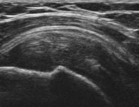 Musculoskeletal Joints and Tendons | 6.1 Shoulder : Case 6.1.5 Rotator ...