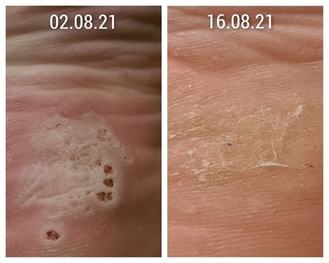 Case Study: Successfully Treating A Foot Covered In Plantar Warts