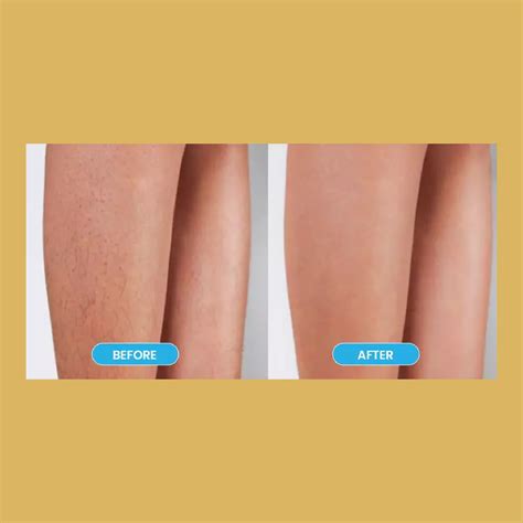 laser hair removal full bikini 1