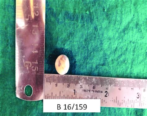 photomicrograph showing gross specimen  scientific diagram