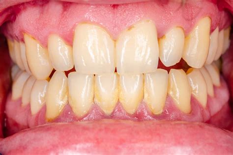 Gingivitis - Online Dental Care
