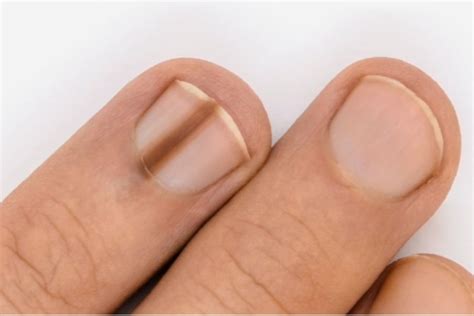 Ongle noir : causes, solutions et traitements