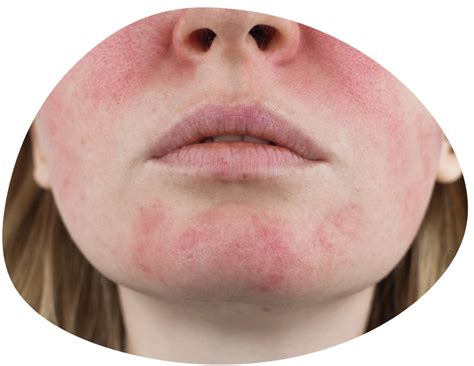 skin redness treatment dermdox skin solutions