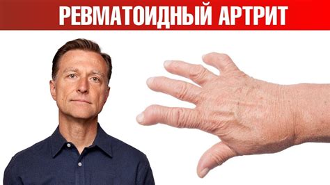 13 натуральных средств от ревматоидного артрита👌 - YouTube
