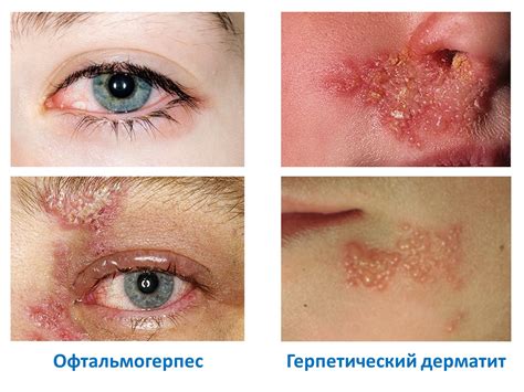 Как выглядит герпес на глазах фото