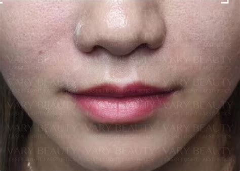 Stem Cell Filler Pen - Vary Beauty