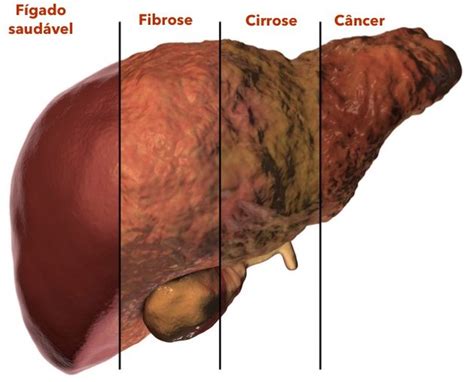 O Que É Fibrose No Fígado - Índices APRI e FIBROTEST para avaliação da função do fígado — ANDREIA ...