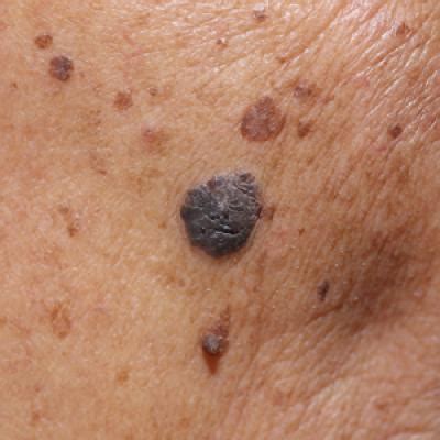 Reflectance Confocal Microscopy to Facilitate Knifeless Skin Cancer ...