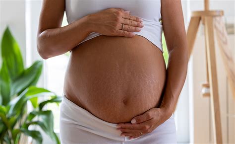 how long do stretch marks take to fade
