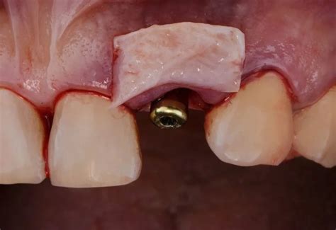 how to know if gum graft failed