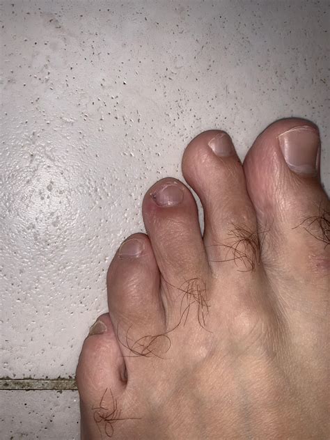 Middle toenail has started in-growing : r/ingrowntoenails