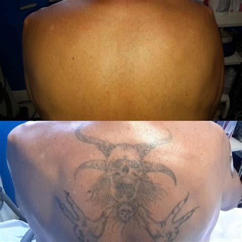 Expert Laser Tattoo Removal Orlando, Winter Park Tattoo Removal