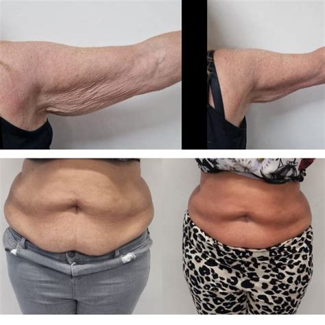 liquid lipo fat dissolving gel cheshire skin laser clinic