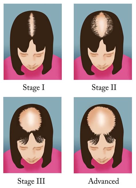Medical for Us: Hair Loss : Types, Cause, Prevention, Treatment