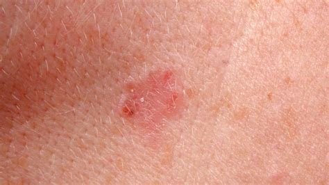 What Is The Difference Between Superficial Basal Cell Carcinoma And ...