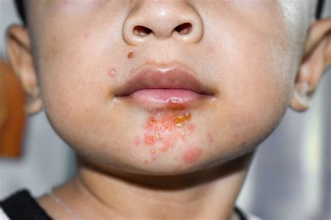 impetigo  symptoms treatment options