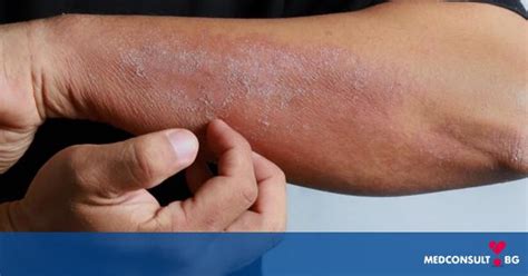 Как е възможно да се справим в псориазиса — MedConsult.bg