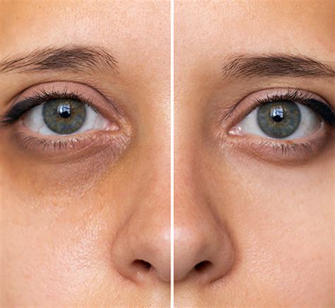 laser treatment  dark circles  delhi safe effective