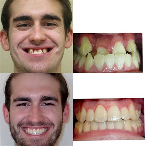 Orthodontist Braces Before And After