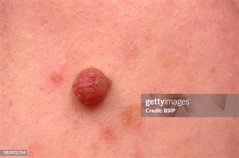 106 Mole On Cheek Stock Photos, High-Res Pictures, and Images - Getty ...