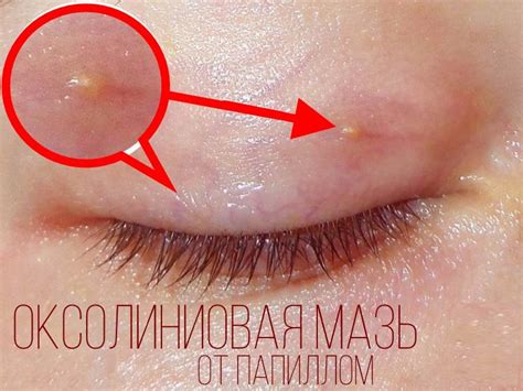 Оксолиновая мазь от папиллом, кондилом и бородавок: обзор, рекомендации ...