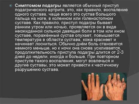Презентация на тему Подагра ВЫПОЛНИЛА СТУДЕНТКА ГРУППЫ