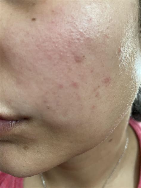 [skin concern] red blemishes and splotches all over skin. Routine in