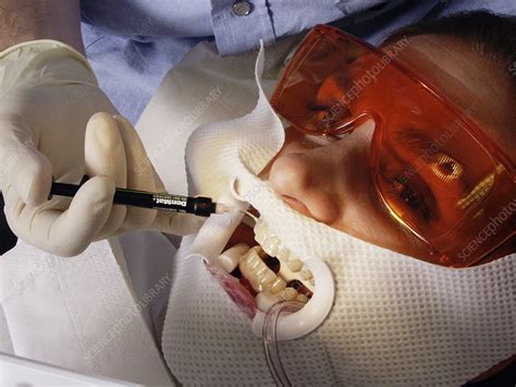 teeth bleaching stock image  science photo library