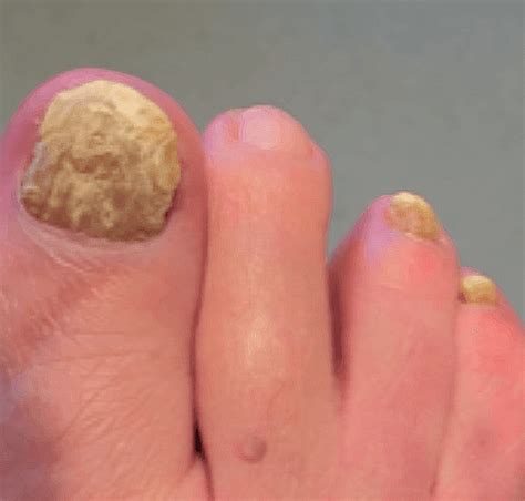 toe skin fungus