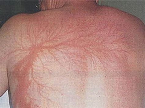 dieu gi xay ra voi nguoi song sot sau khi bi set danh doctor  san