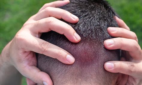 What causes a dry scalp? – 3P Cell