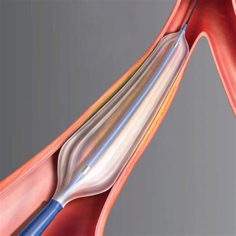 lifestream balloon expendable vascular covered stent syaf unica indonesia