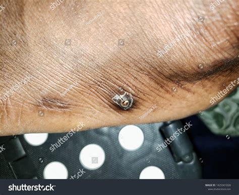 how to treat an infected splinter at home