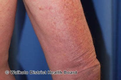 rashes   treatment riva dermatology