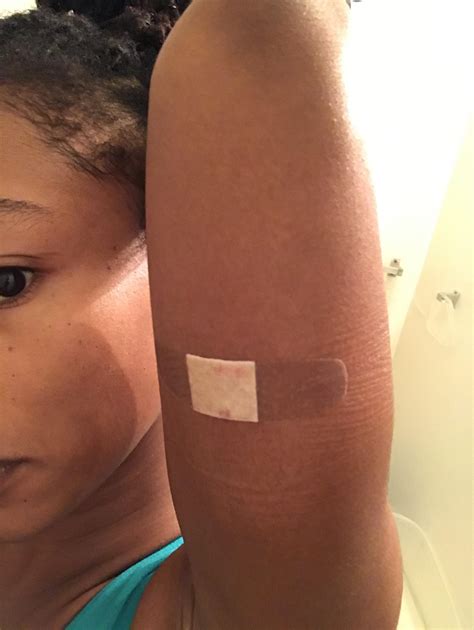 Nexplanon insertion, no bruising the morning after! : r/birthcontrol