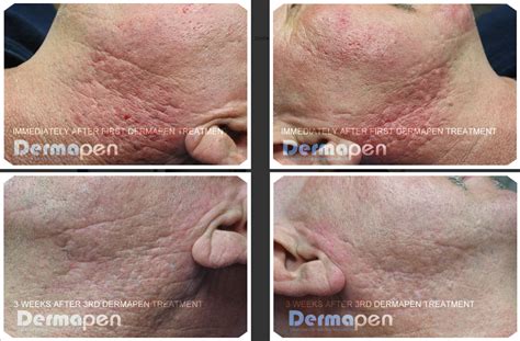 Dermapen Before and After - Cosmetic Skin Institute | Skin Care in Washington DC, Olney, & Maryland