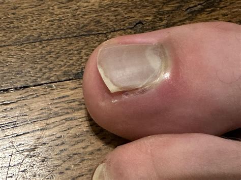 Marathon training… Painful : r/Ingrown_Toenails