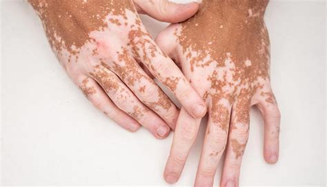 common skin diseases health service navigator